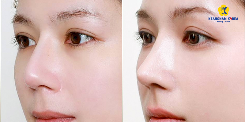 Tháo sụn mũi đã nâng có an toàn không? kinh nghiệm tháo mũi đã nâng không thể không biết 4 tháo sụn mũi sau khi nâng