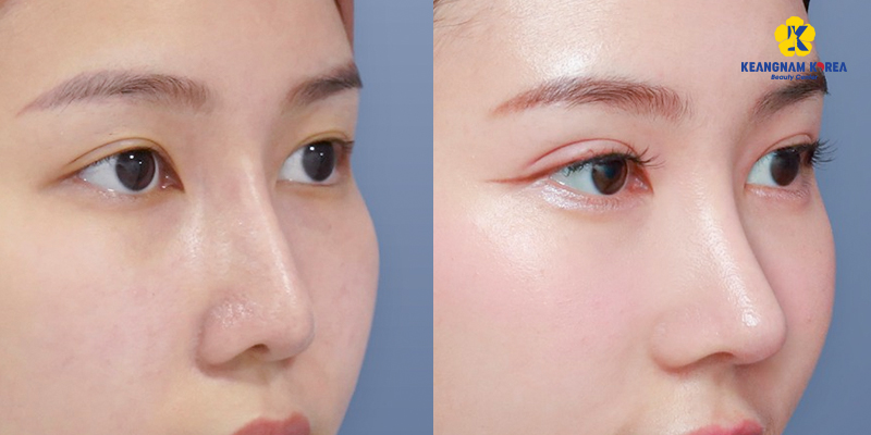 Tháo sụn mũi đã nâng có an toàn không? kinh nghiệm tháo mũi đã nâng không thể không biết 5 tháo mũi đã nâng