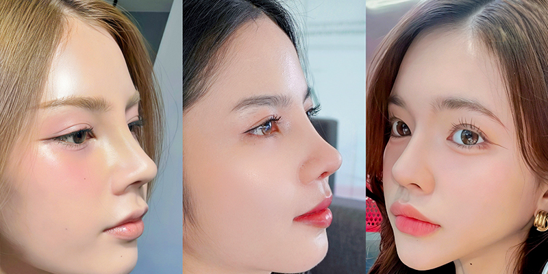 Tháo sụn mũi đã nâng có an toàn không? kinh nghiệm tháo mũi đã nâng không thể không biết 1 thao sun mui da nang