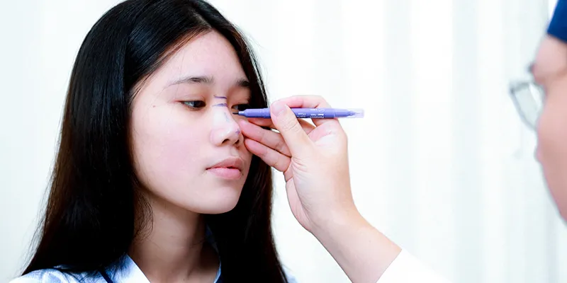 Thu gọn đầu mũi giá bao nhiêu? Bao lâu hết sưng? Có vĩnh viễn không? Các combo kết hợp để đạt dáng mũi như mong đợi 2 Thu gọn đầu mũi giá bao nhiêu