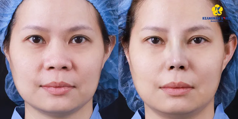 Thu gọn đầu mũi giá bao nhiêu? Bao lâu hết sưng? Có vĩnh viễn không? Các combo kết hợp để đạt dáng mũi như mong đợi 3 Hình ảnh trước và sau khi Thu gọn đầu mũi