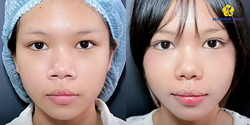 Thu gọn đầu mũi giá bao nhiêu? Bao lâu hết sưng? Có vĩnh viễn không? Các combo kết hợp để đạt dáng mũi như mong đợi 4 hình ảnh trước và sau Thu nhỏ đầu mũi