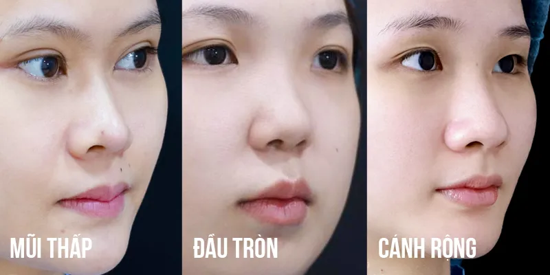 Thu gọn đầu mũi giá bao nhiêu? Bao lâu hết sưng? Có vĩnh viễn không? Các combo kết hợp để đạt dáng mũi như mong đợi 6 Thu gọn đầu mũi giá bao nhiêu