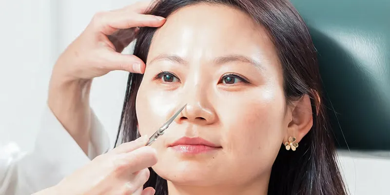 Đâu là cách thu nhỏ cánh mũi không phẫu thuật hiệu quả thực tế? 2 cách thu nhỏ cánh mũi không phẫu thuật