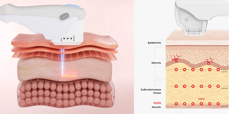 Đâu là cách thu nhỏ cánh mũi không phẫu thuật hiệu quả thực tế? 4 cách thu nhỏ cánh mũi không phẫu thuật HIFU