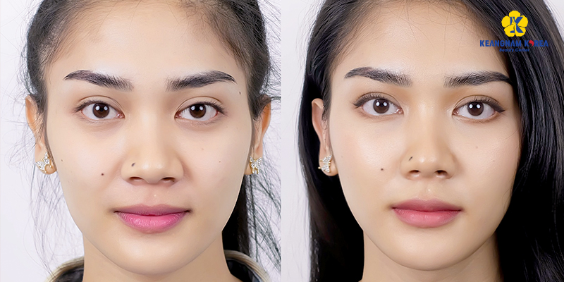 Tiêm gọn cánh mũi có những phương pháp nào? 4 tiêm gọn cánh mũi