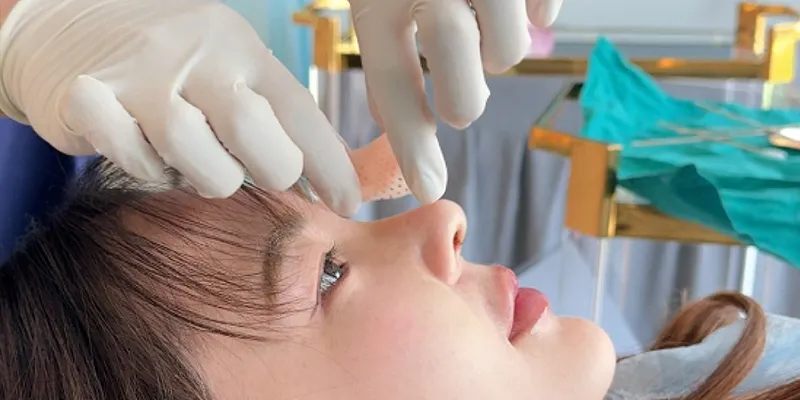 triệu chứng sau khi nâng mũi