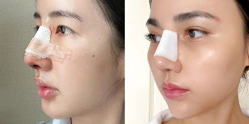 Các triệu chứng sau khi nâng mũi cần lưu ý trong 3 tháng đầu: đâu là dấu hiệu bình thường, đâu là dấu hiệu bất thường? 3 triệu chứng sau khi nâng mũi