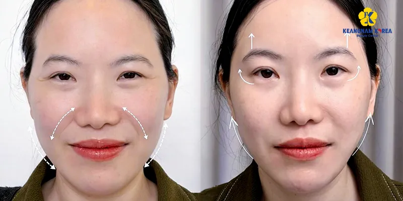 Căng chỉ trẻ hóa da 3 vùng dưới đây sẽ giúp "đóng băng" độ tuổi trên da 5 Căng chỉ vùng mắt