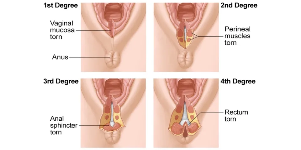 Phẫu thuật tầng sinh môn là gì? Quy trình, bảng giá và những lưu ý cần biết sau khi sinh 2 4 cấp độ rách của tầng sinh môn khi sinh thường