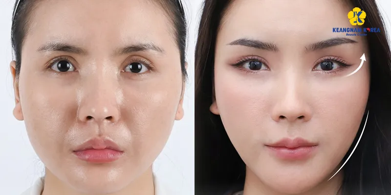 Khóe mắt sâu là gì? 3 cách làm đầy rãnh lệ, xóa thâm mắt hiệu quả nhất 2026 4 3 cách làm đầy rãnh lệ hiện nay