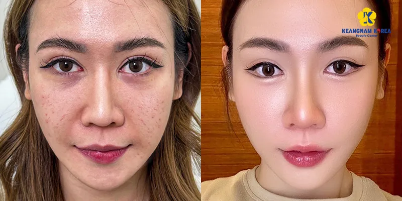 No-needle Mesotherapy Cost: How Much It Is and How Long Results Last 5 needle-free mesotherapy before and after
