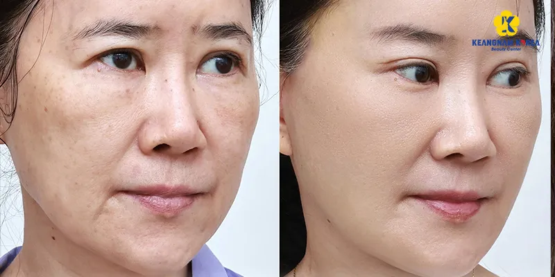 No-needle Mesotherapy Cost: How Much It Is and How Long Results Last 7 needle-free mesotherapy at keannam korea