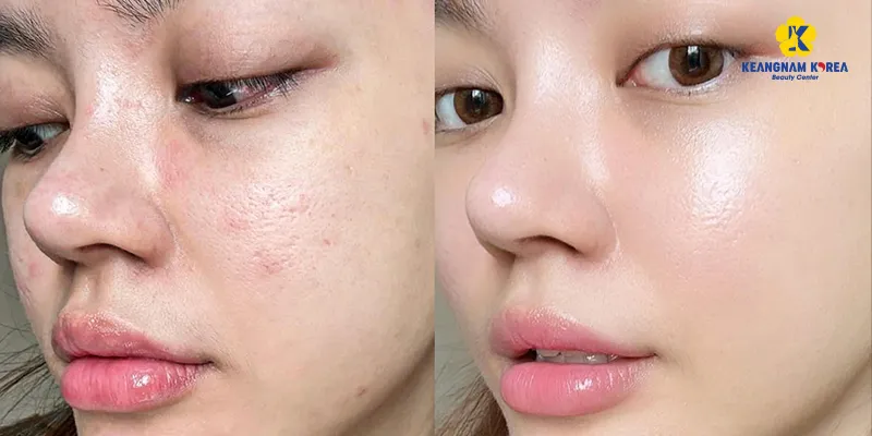 No-needle Mesotherapy Cost: How Much It Is and How Long Results Last 6 needle-free mesotherapy before and after at keangnam korea