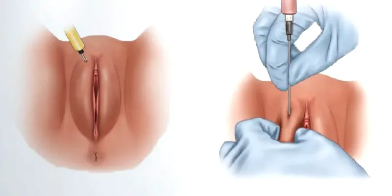 5 công nghệ trẻ hóa vùng kín không phẫu thuật an toàn, “nhẹ nhàng” với cô bé 4 Tiem tre hoa vung kin