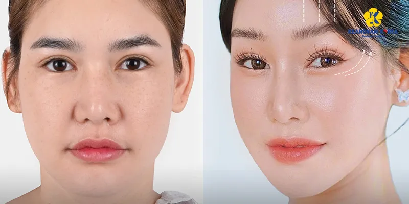 Đuôi mắt hướng xuống là tốt hay xấu? 3 cách lấy lại "linh hồn" cho đuôi mắt xệ 5 phẫu thuật nâng đuôi mắt