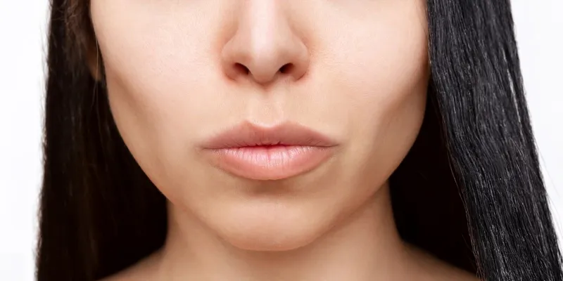 Cấy chỉ collagen làm đầy má hóp có hiệu quả không? Giữ được bao lâu? Ưu nhược điểm là gì? 2 Cấy chỉ collagen làm đầy má hóp