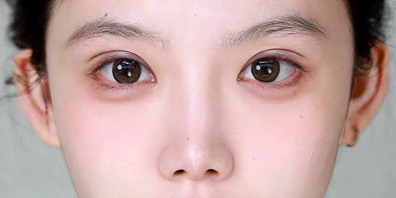 bọng mắt hàn quốc