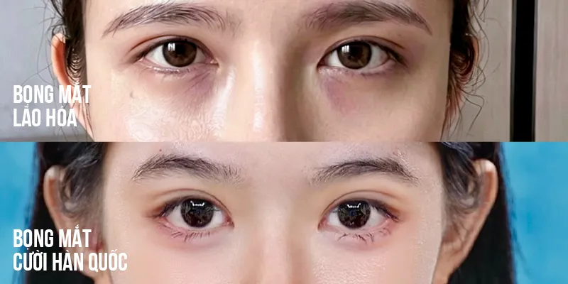 Bọng mắt Hàn Quốc là gì? 4 cách sở hữu bọng mắt cười Aegyo-sal lôi cuốn 2 bọng mắt cười hàn quốc