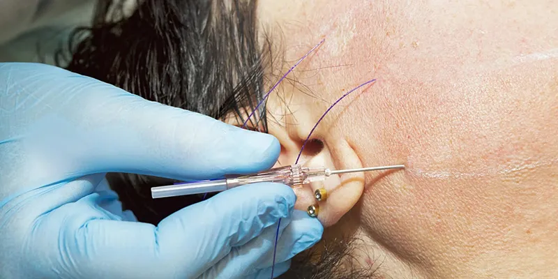 7 Dấu hiệu căng chỉ bị hỏng khi căng chỉ da mặt và cách nhận biết chính xác nhất 2 căng chỉ da mặt có nguy hiểm không