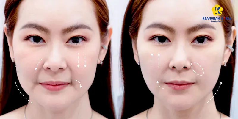 Căng chỉ da mặt là gì? Những công nghệ trẻ hóa "không dao kéo" toàn diện nhất 2026 5 Căng chỉ vàng là gì