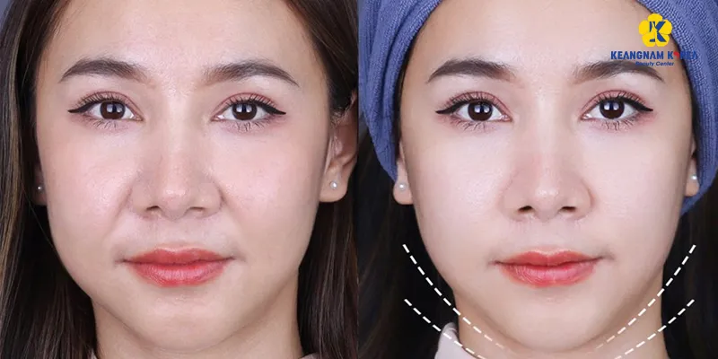 Căng chỉ trẻ hóa da 3 vùng dưới đây sẽ giúp "đóng băng" độ tuổi trên da 2 Căng chỉ trẻ hóa da có tác dụng gì