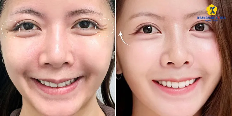 Căng chỉ trẻ hóa da 3 vùng dưới đây sẽ giúp "đóng băng" độ tuổi trên da 6 Căng chỉ trẻ hóa đuôi mắt
