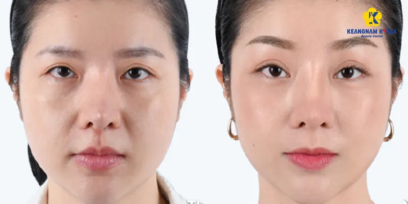 Khóe mắt sâu là gì? 3 cách làm đầy rãnh lệ, xóa thâm mắt hiệu quả nhất 2026 3 3 cách làm đầy rãnh mắt hiện nay