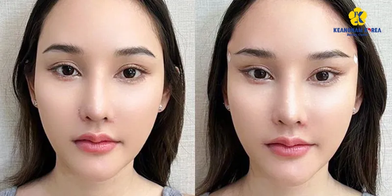 Căng chỉ mắt cáo là gì? Sở hữu đôi mắt sắc sảo không cần phẫu thuật chỉ trong chớp mắt 3 cang chi mat cao la gi 1
