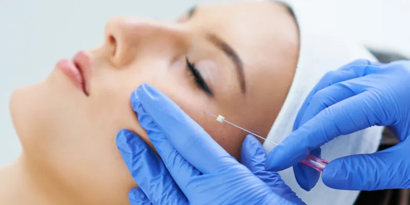 Căng chỉ mắt cáo là gì? Sở hữu đôi mắt sắc sảo không cần phẫu thuật chỉ trong chớp mắt 6 cang chi mat cao o dau