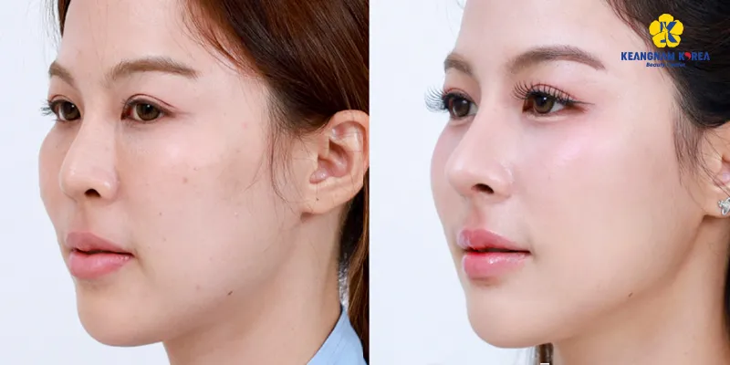 Căng chỉ mũi có an toàn không? Những điều cần biết trước khi quyết định 3 căng chỉ mũi có an toàn không