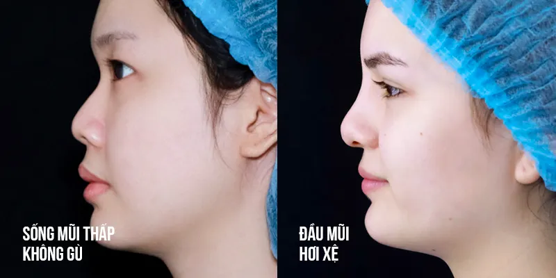 Căng chỉ mũi có an toàn không? Những điều cần biết trước khi quyết định 4 căng chỉ mũi có an toàn không