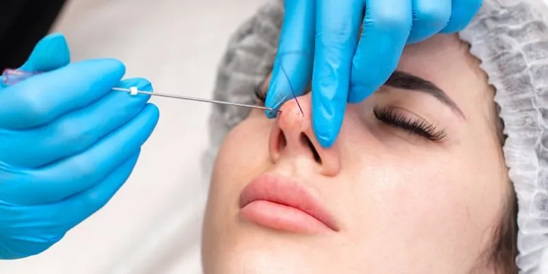 Căng chỉ mũi có an toàn không? Những điều cần biết trước khi quyết định 5 căng chỉ mũi có an toàn không