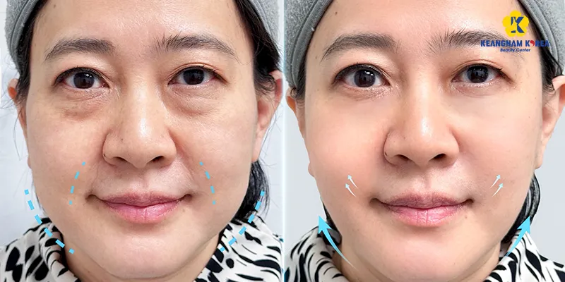 Căng chỉ trẻ hóa da 3 vùng dưới đây sẽ giúp "đóng băng" độ tuổi trên da 4 Căng chỉ rãnh cười