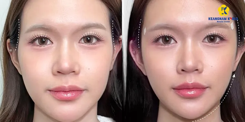 Căng chỉ trẻ hóa da 3 vùng dưới đây sẽ giúp "đóng băng" độ tuổi trên da 8 Căng chỉ trán