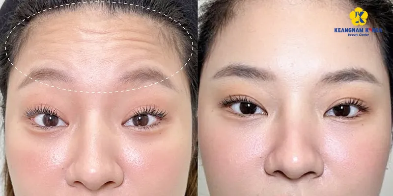 Căng chỉ trẻ hóa da 3 vùng dưới đây sẽ giúp "đóng băng" độ tuổi trên da 7 Căng chỉ thái dương