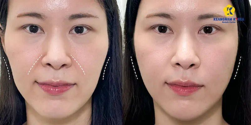 Cấy chỉ collagen làm đầy má hóp có hiệu quả không? Giữ được bao lâu? Ưu nhược điểm là gì? 4 Cấy chỉ collagen làm đầy má hóp