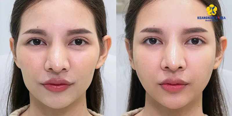 Cấy chỉ collagen làm đầy má hóp có hiệu quả không? Giữ được bao lâu? Ưu nhược điểm là gì? 3 Cấy chỉ collagen làm đầy má hóp