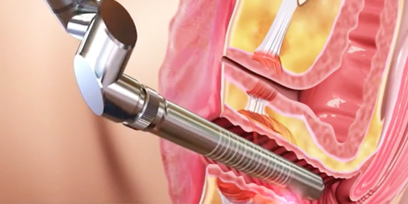 Có nên thu hẹp vùng kín sau sinh không? Khác biệt về sinh thường và sinh mổ 2 co nen thu hep vung kin bang laser 1