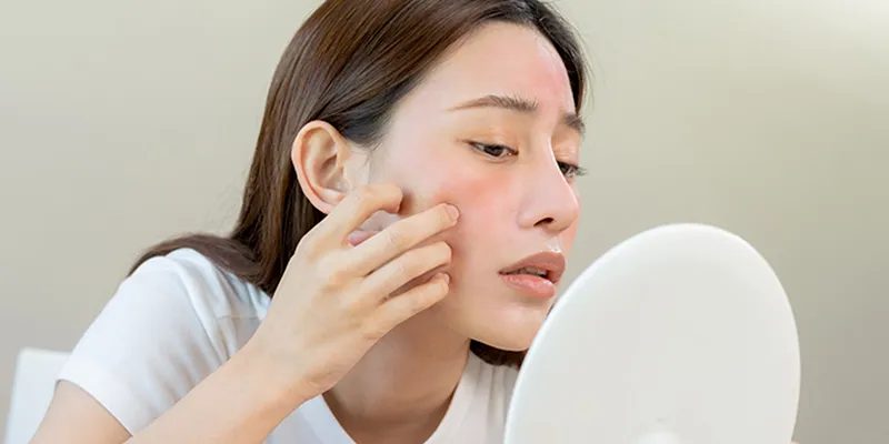 7 Dấu hiệu căng chỉ bị hỏng khi căng chỉ da mặt và cách nhận biết chính xác nhất 4 Dấu hiệu căng chỉ bị hỏng