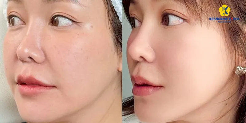 Đeo đai nâng cơ mặt có hiệu quả không? 5 căng chỉ nâng cơ mặt có hiệu quả không