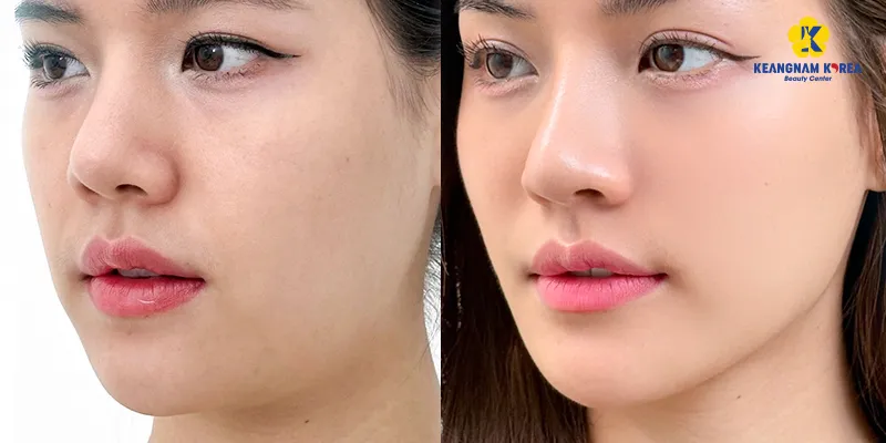 Đeo đai nâng cơ mặt có hiệu quả không? 4 meso nâng cơ mặt có hiệu quả không