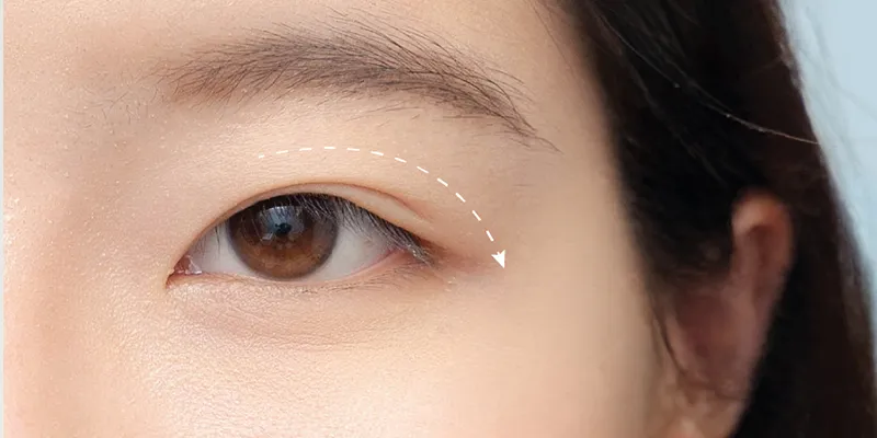 Căng chỉ nâng đuôi mắt