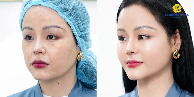 4 cách làm đầy má hóp không phẫu thuật an toàn & hiệu quả nhất 2026 2 làm đầy má hóp không phẫu thuật