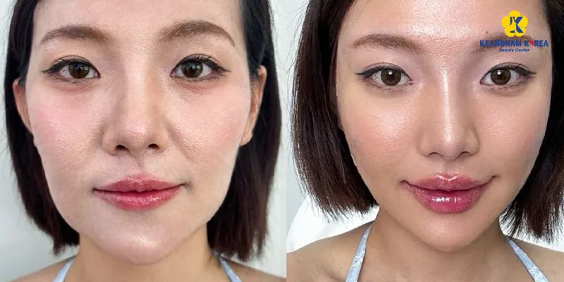 Làm đầy má hóp vĩnh viễn được không? Gồm những cách nào? 2 làm đầy má hóp vĩnh viễn