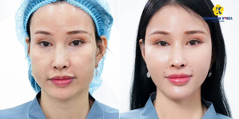 4 cách làm đầy má hóp không phẫu thuật an toàn & hiệu quả nhất 2026 3 làm đầy má hóp không phẫu thuật