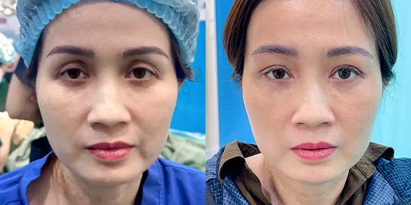 Hốc mắt sâu trong tướng số nói lên điều gì ở nam và nữ? Cát hay hung? Cách hóa giải để đổi vận 2 Hốc mắt sâu trong tướng số ở phụ nữ