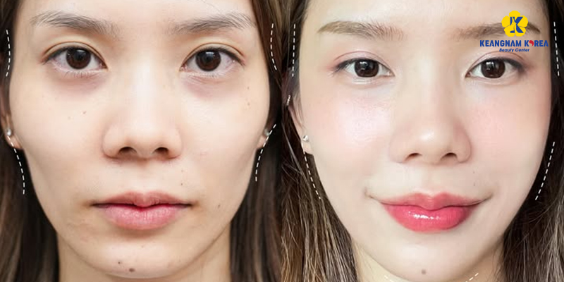 Có nên làm đầy má hóp bằng mỡ tự thân? Phân tích chuyên sâu từ góc nhìn chuyên môn 3 làm đầy má hóp bằng mỡ tự thân
