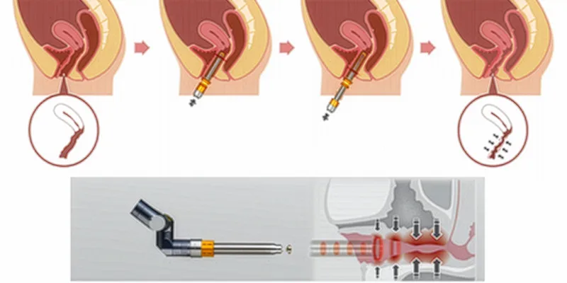 Laser Làm Hồng Âm Đạo Có Hiệu Quả Không? Ưu Nhược Điểm Là Gì? Liệu Đây Có Phải Lựa Chọn Đúng? 2 Ưu điểm của phương pháp làm hồng âm đạo bằng laser