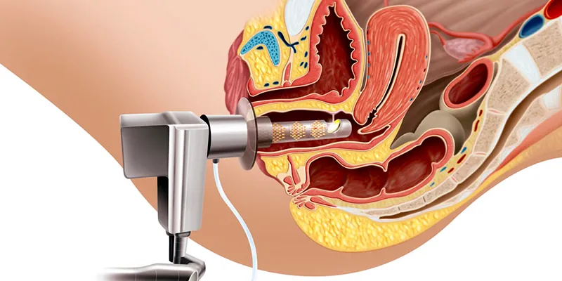 Làm hồng se khít vùng kín bằng phương pháp nào tốt? 2 Laser làm hồng se khít vùng kín